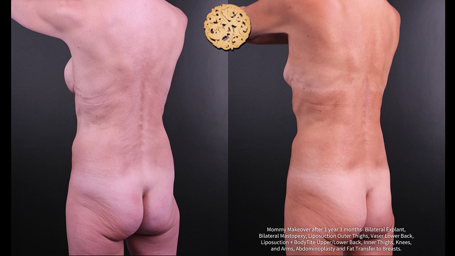 Fat Transfer To Breasts Before & After