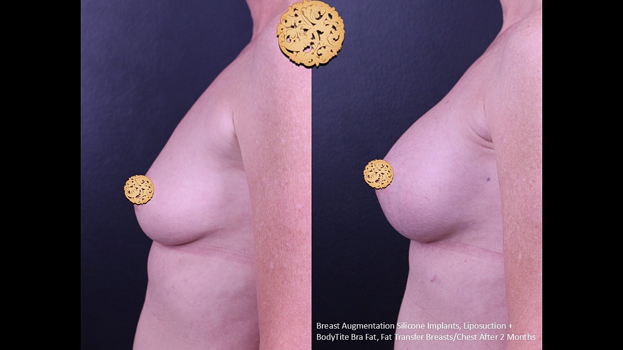 Before and after breast augmentation transformation.
