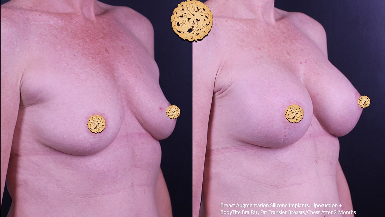 Before and after breast augmentation surgery comparison.