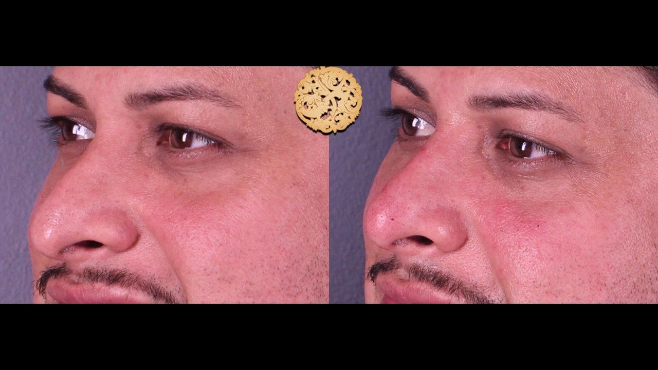 Non Surgical Nose Job Before & After