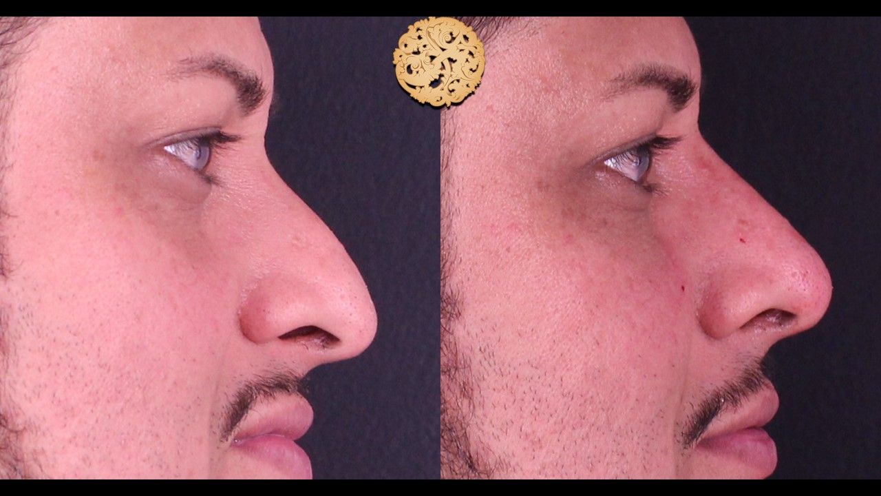 Non Surgical Nose Job Before & After