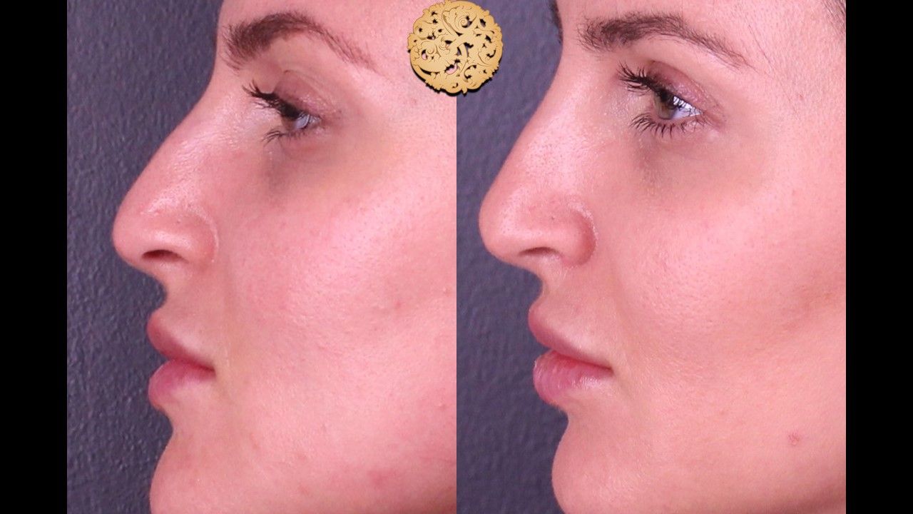 Non Surgical Nose Job Before & After