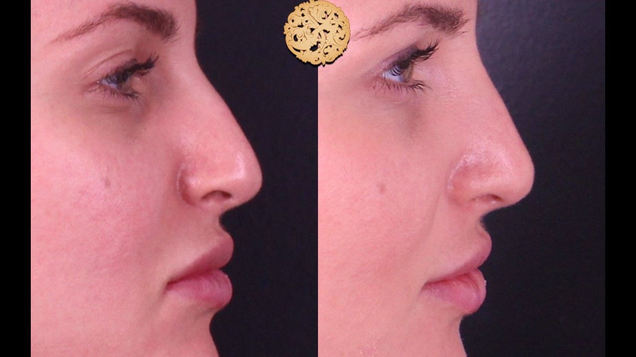 Non Surgical Nose Job Before & After