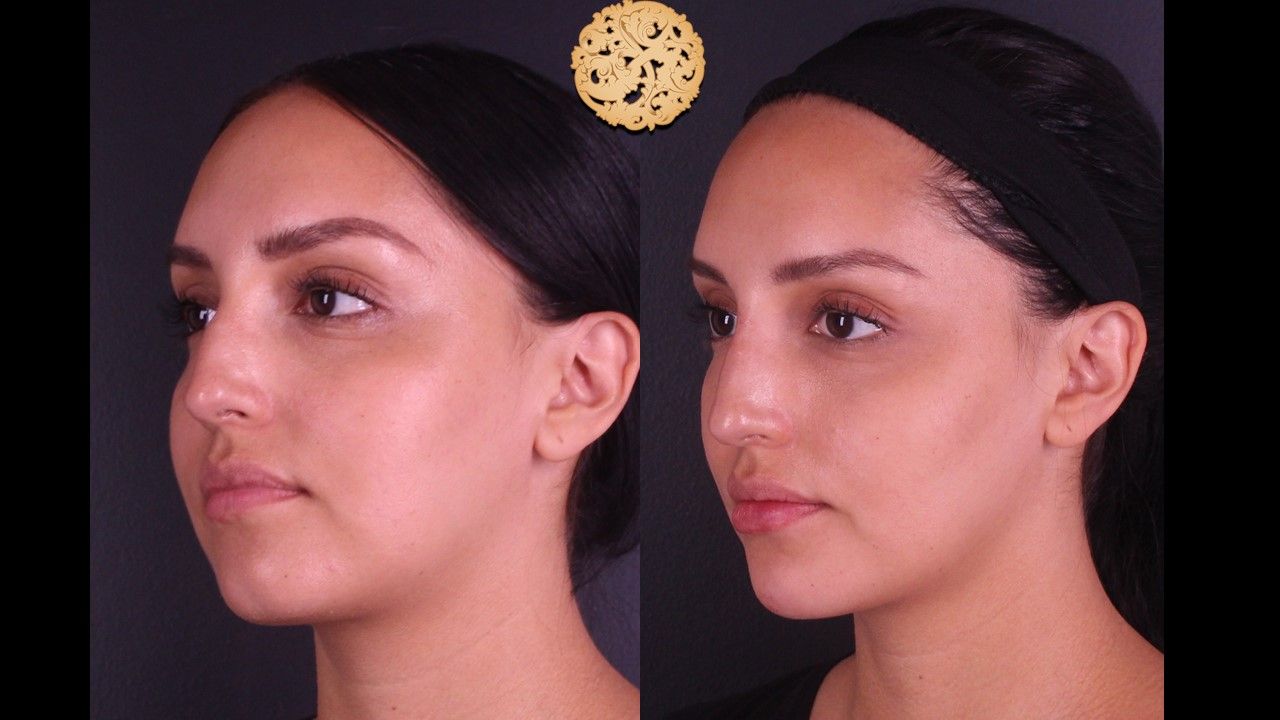 Non Surgical Nose Job Before & After