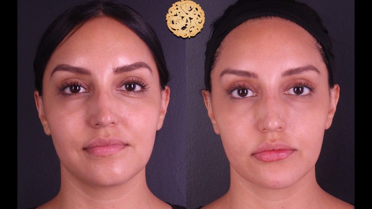 Non Surgical Nose Job Before & After