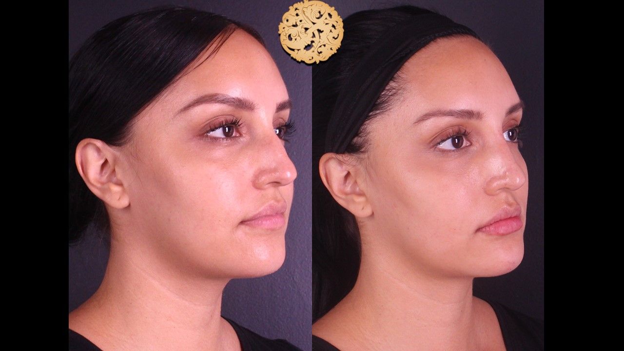 Non Surgical Nose Job Before & After