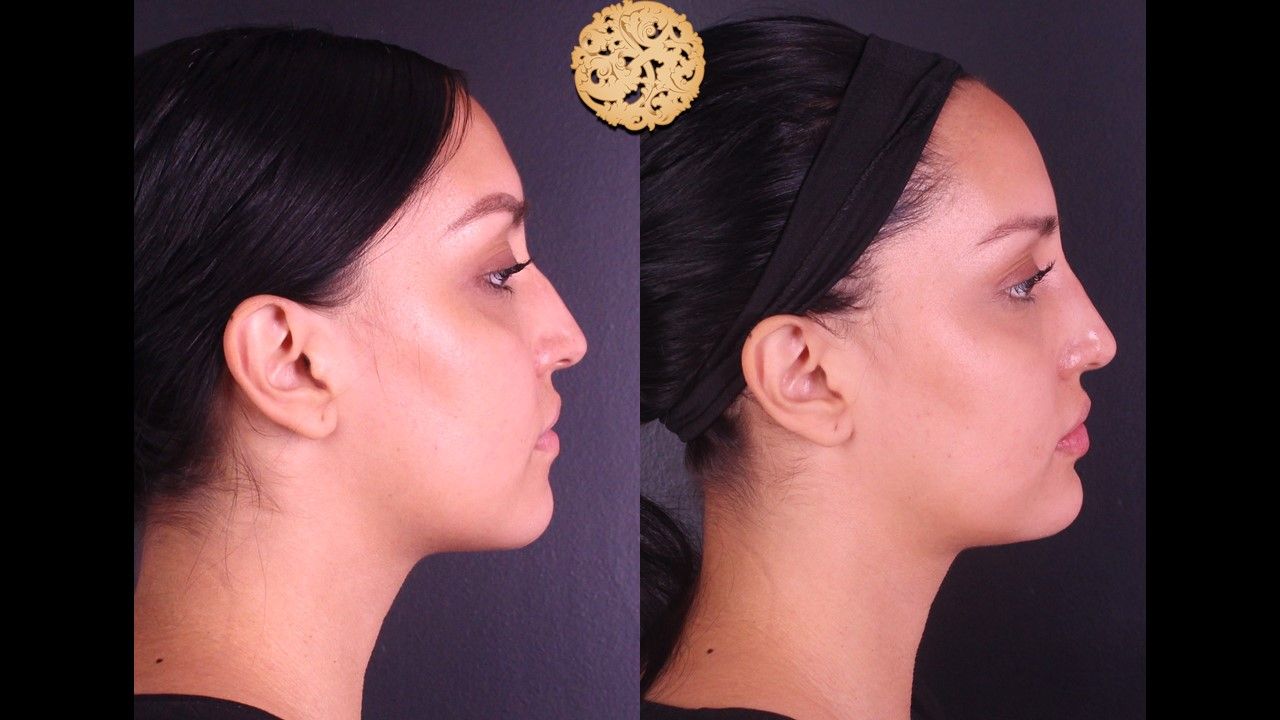 Non Surgical Nose Job Before & After