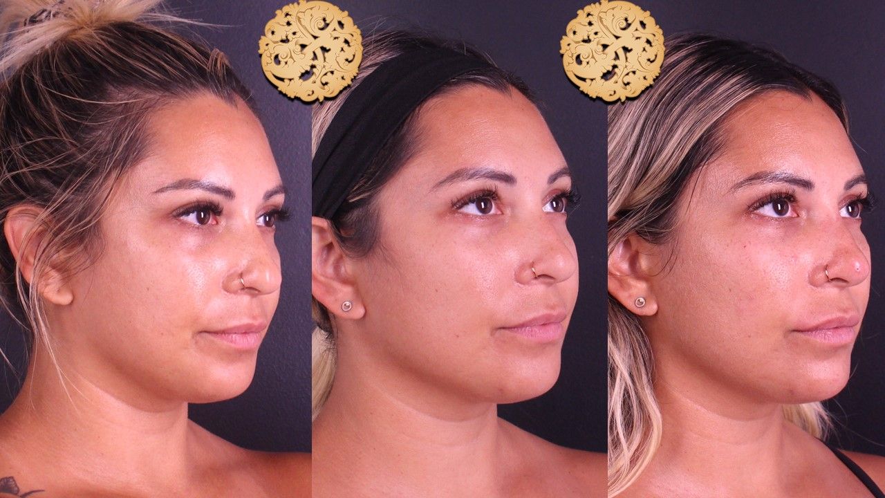 Non Surgical Nose Job Before & After