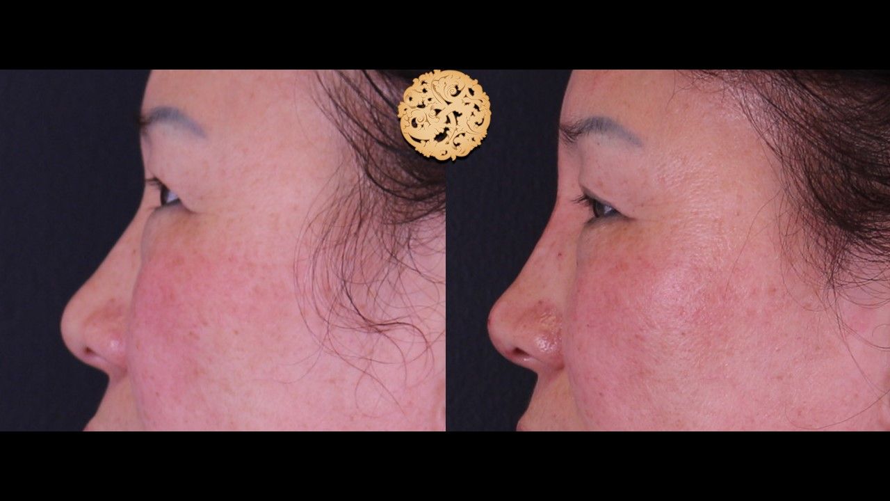 Non Surgical Nose Job Before & After