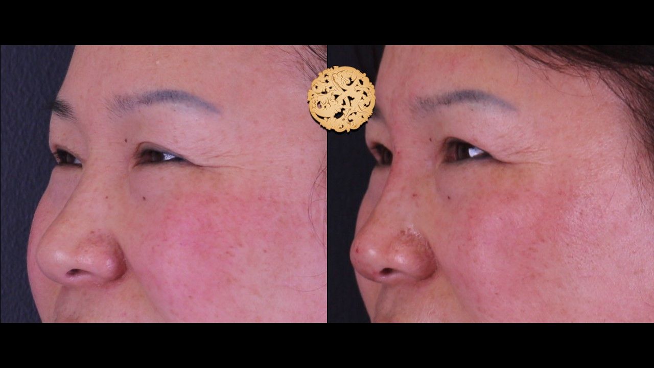 Non Surgical Nose Job Before & After