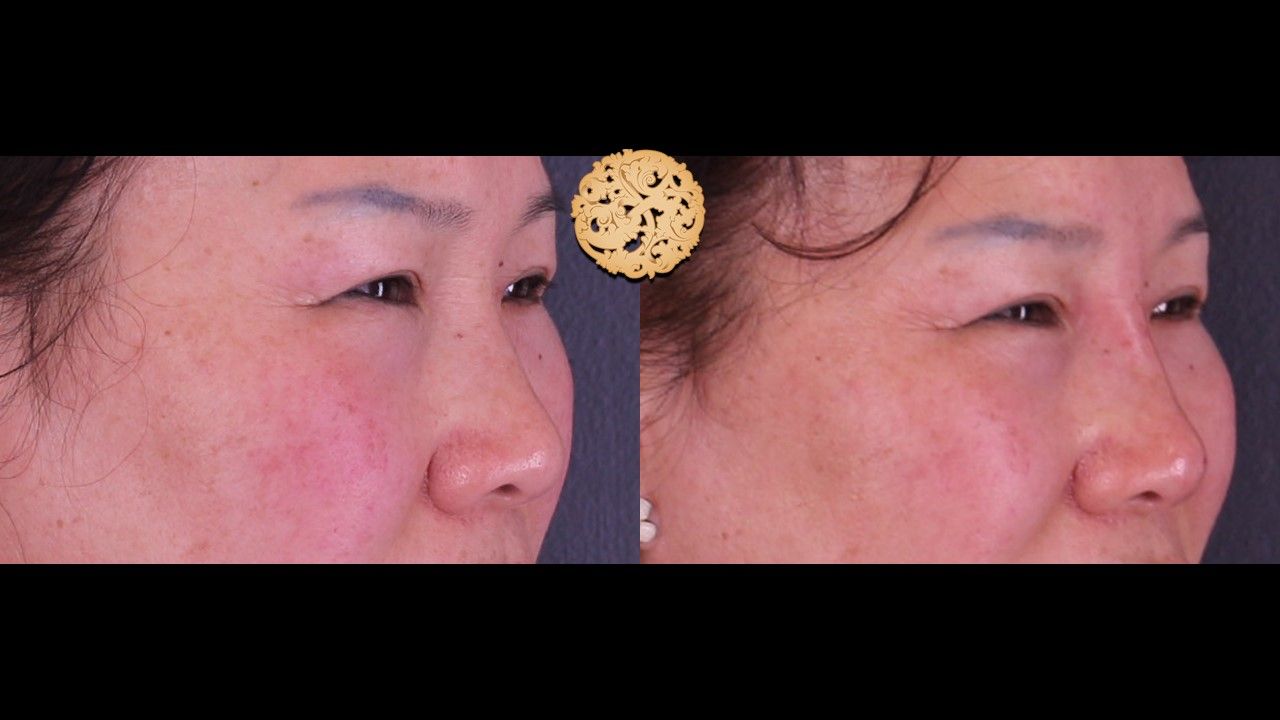 Non Surgical Nose Job Before & After