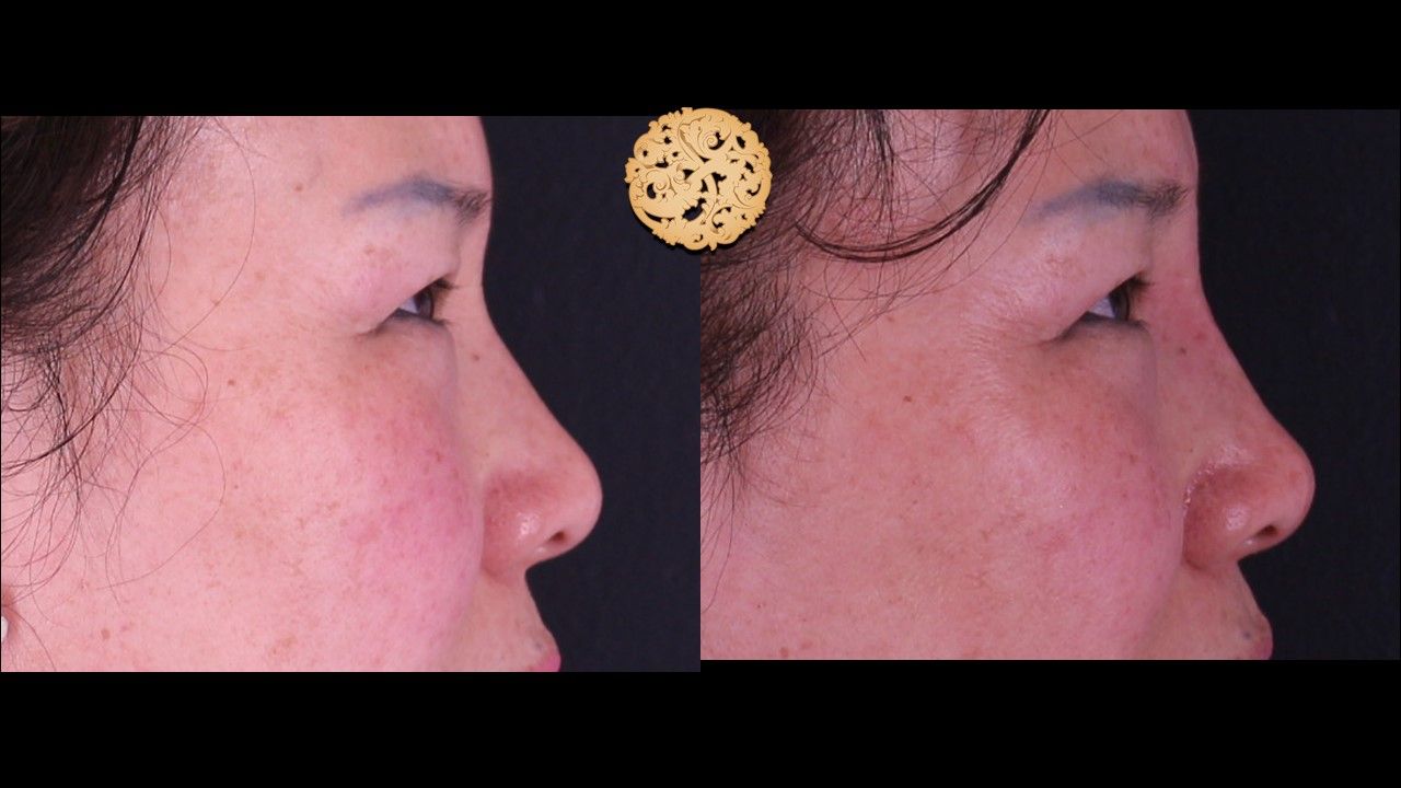 Non Surgical Nose Job Before & After