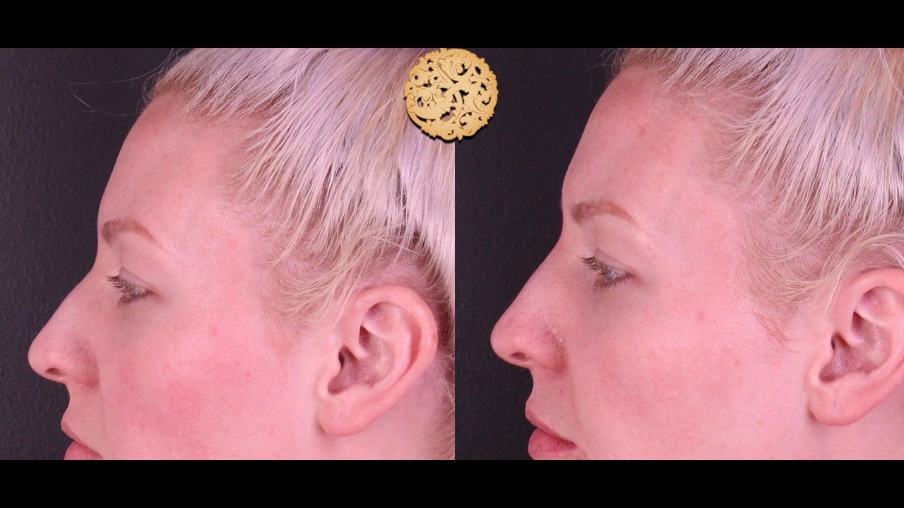 Non Surgical Nose Job Before & After