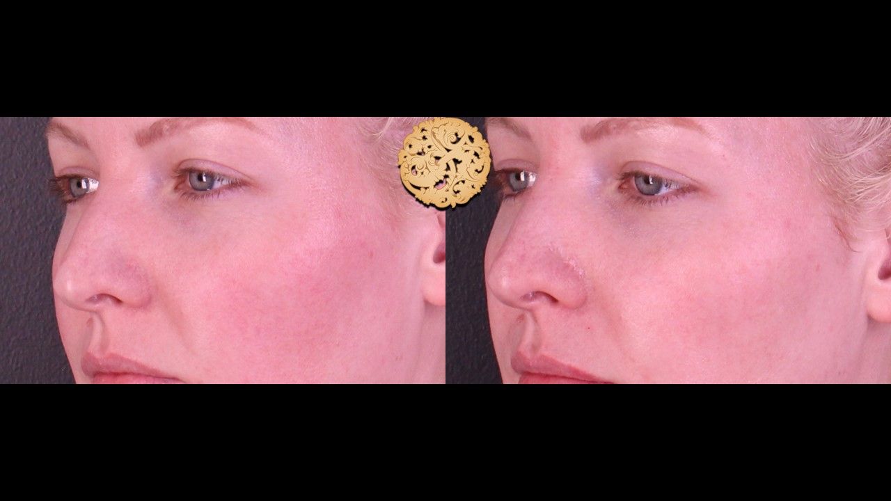 Non Surgical Nose Job Before & After
