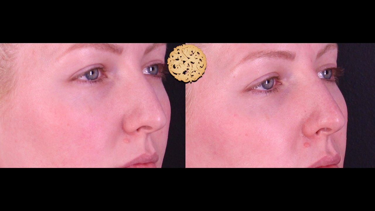 Non Surgical Nose Job Before & After