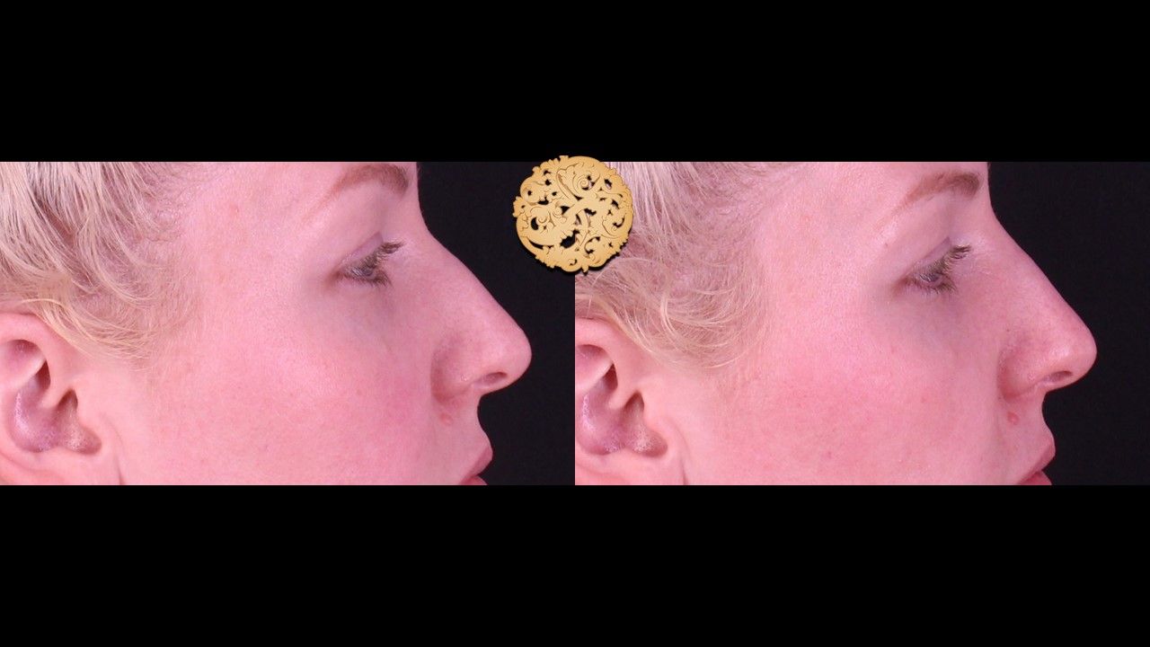 Non Surgical Nose Job Before & After