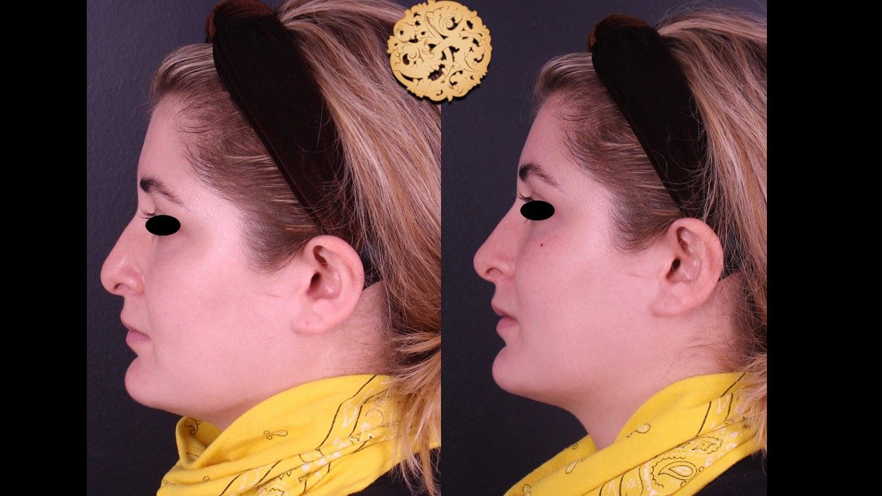 Non Surgical Nose Job Before & After