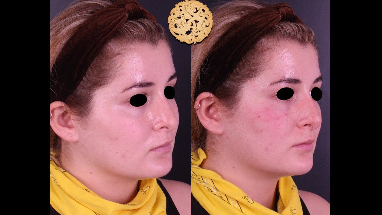 Non Surgical Nose Job Before & After
