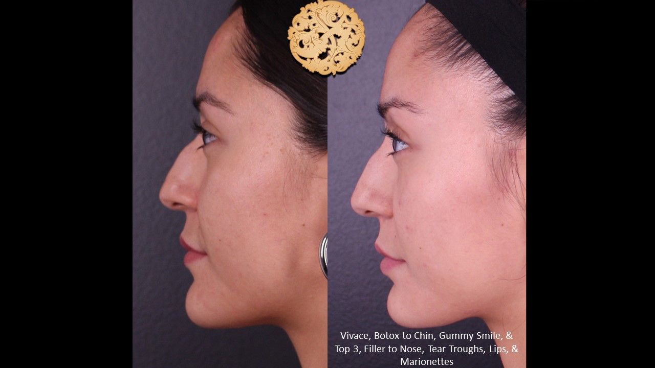 Non Surgical Nose Job Before & After
