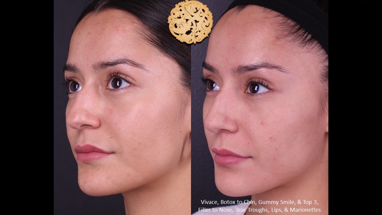 Non Surgical Nose Job Before & After