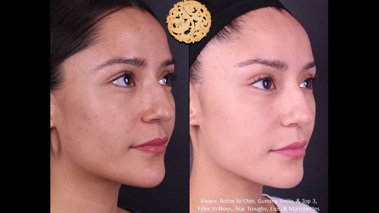 Non Surgical Nose Job Before & After