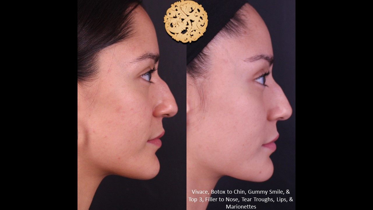 Non Surgical Nose Job Before & After