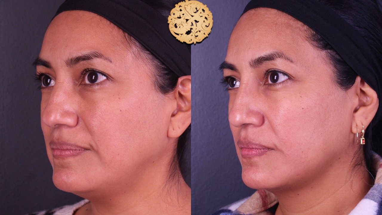 Non Surgical Nose Job Before & After