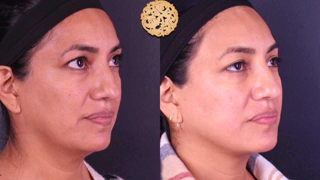 Non Surgical Nose Job Before & After