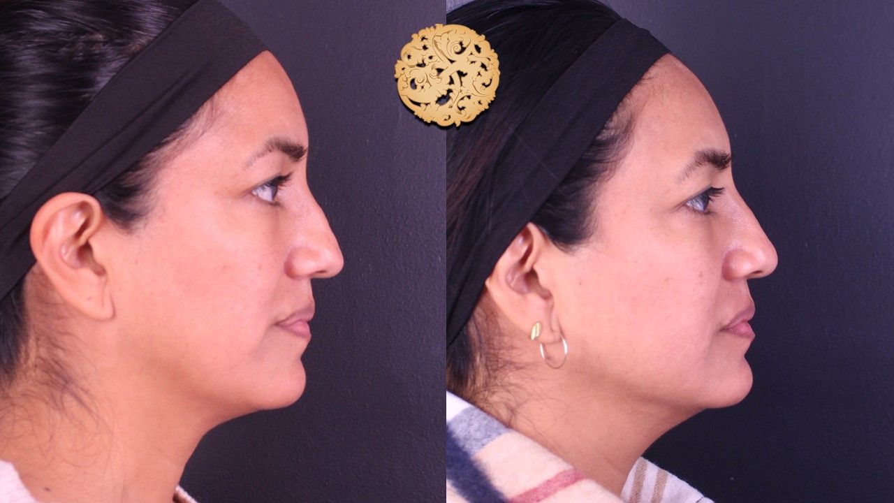 Non Surgical Nose Job Before & After