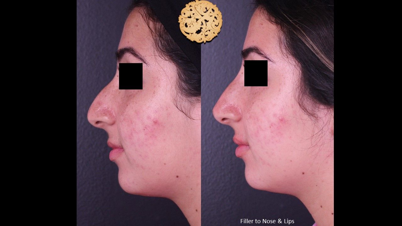 Non Surgical Nose Job Before & After