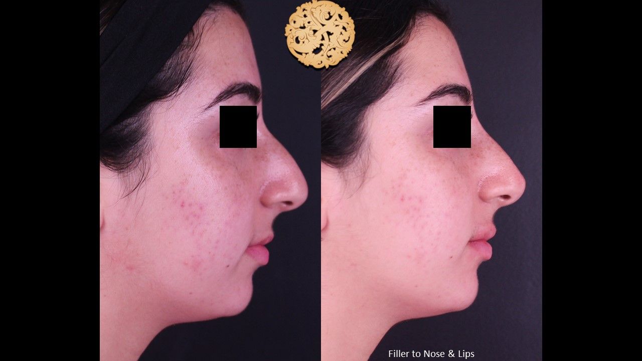 Non Surgical Nose Job Before & After