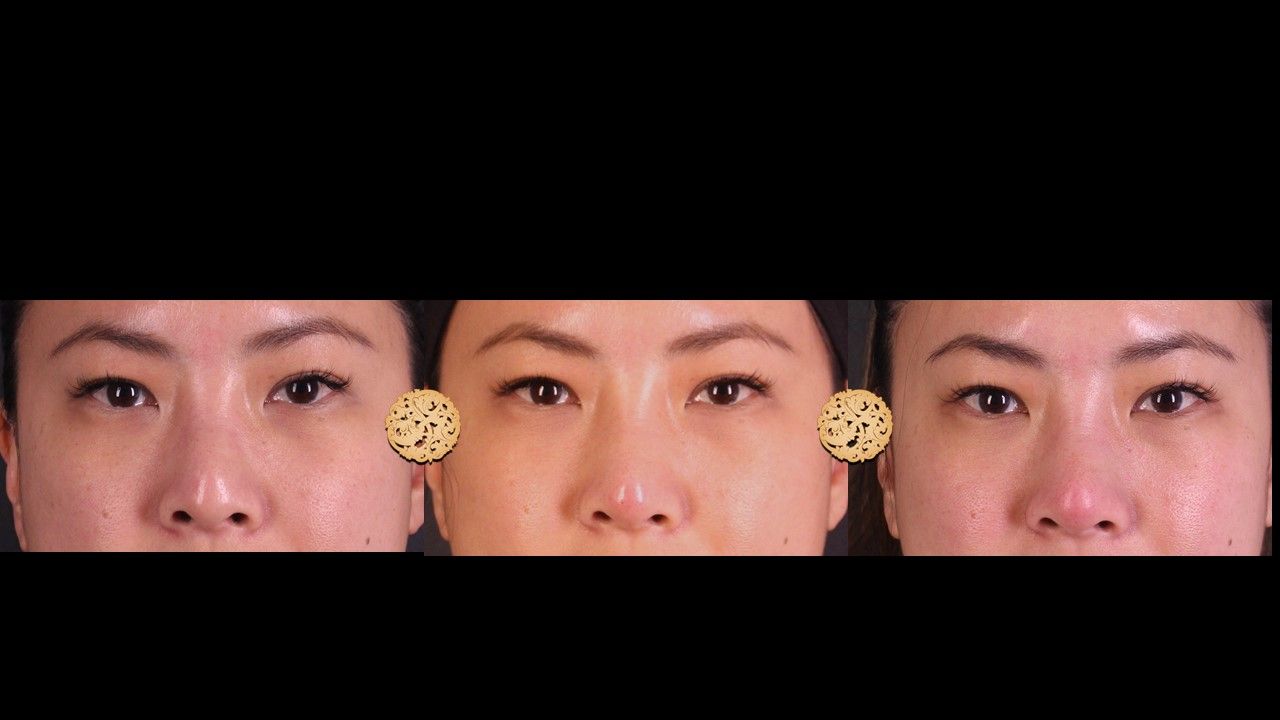 Non Surgical Nose Job Before & After