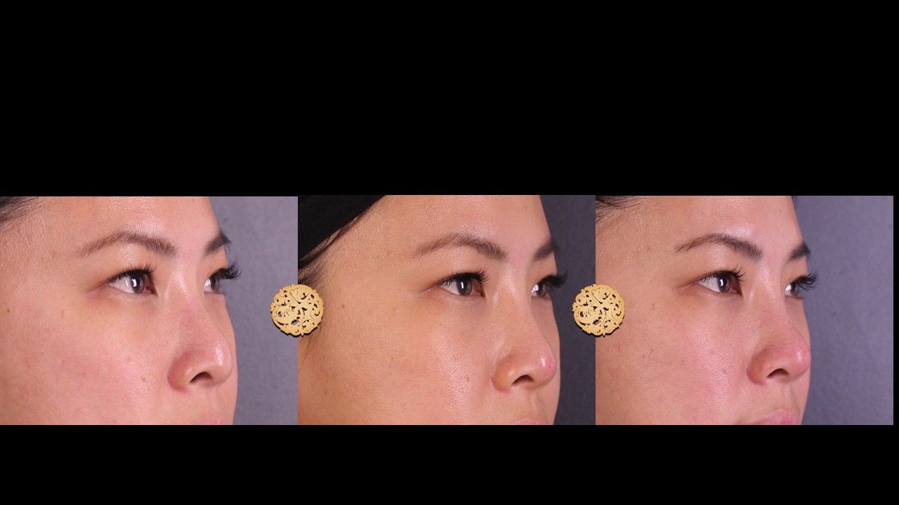 Non Surgical Nose Job Before & After