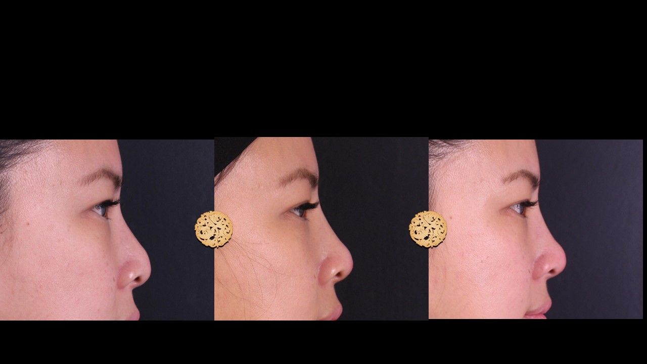 Non Surgical Nose Job Before & After