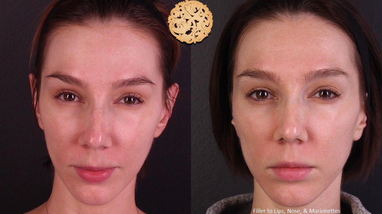 Non Surgical Nose Job Before & After