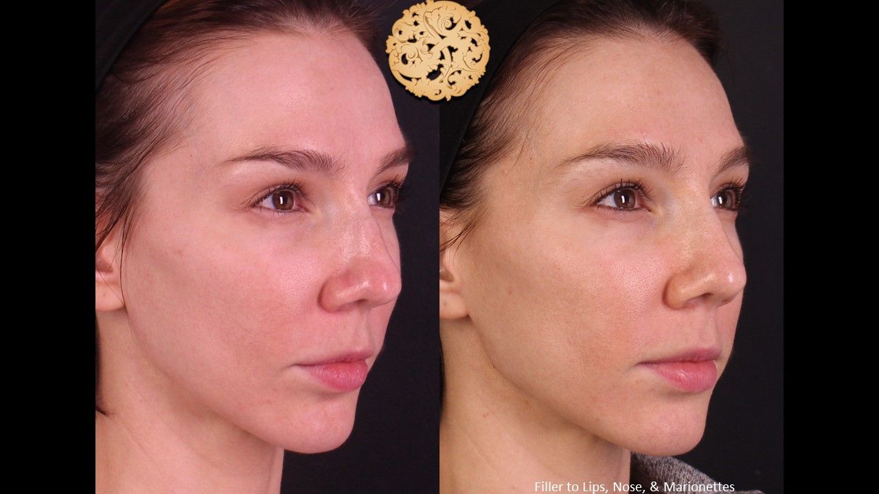 Non Surgical Nose Job Before & After