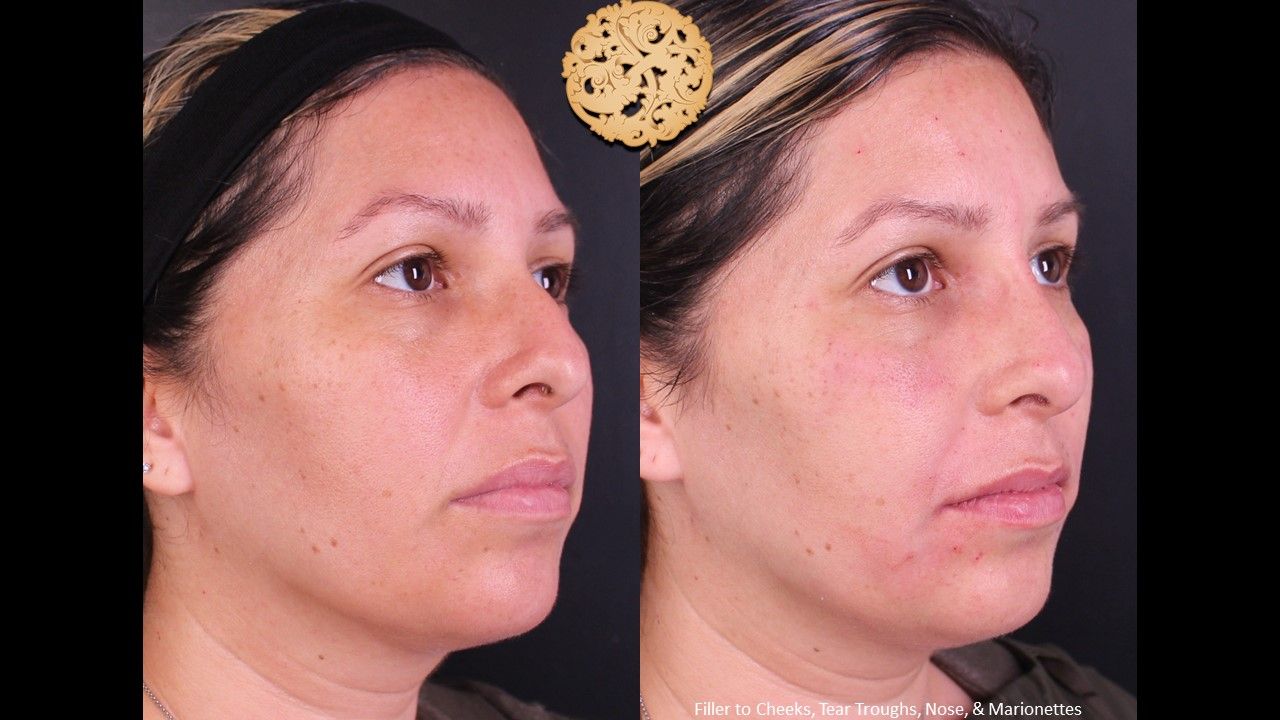 Non Surgical Nose Job Before & After