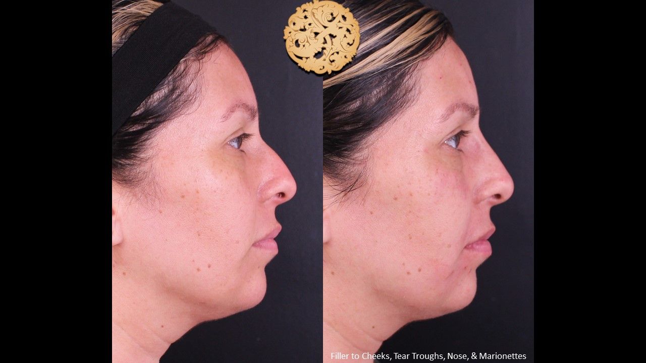 Non Surgical Nose Job Before & After