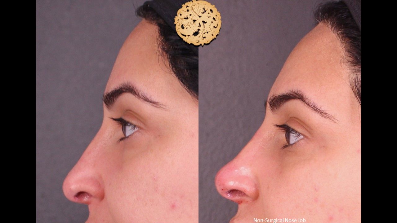 Non Surgical Nose Job Before & After