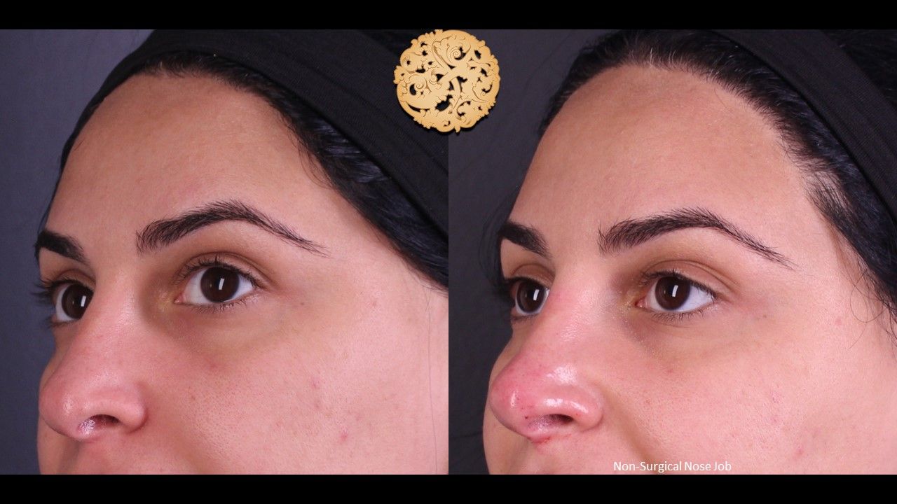 Non Surgical Nose Job Before & After