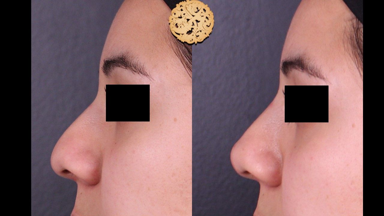 Non Surgical Nose Job Before & After