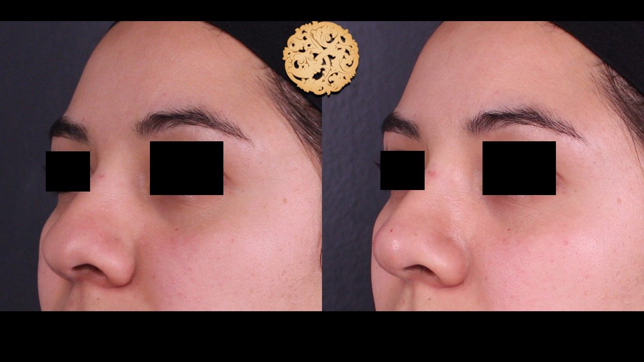Non Surgical Nose Job Before & After