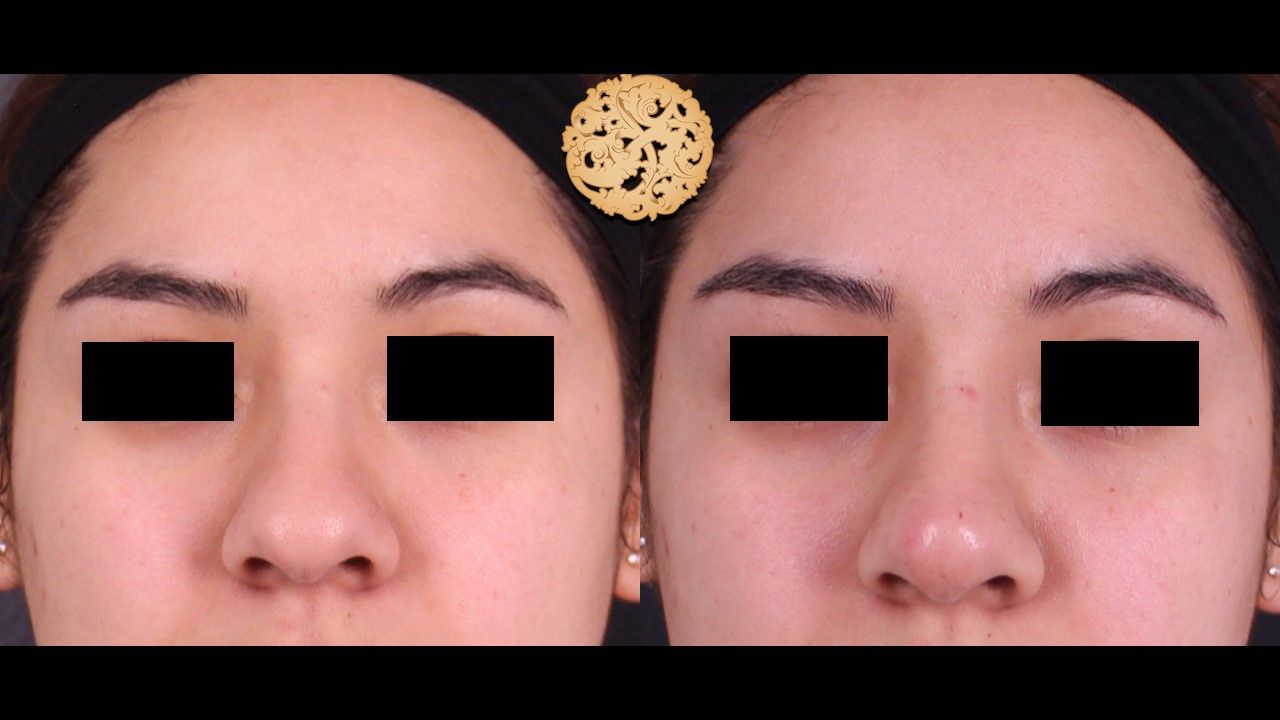 Non Surgical Nose Job Before & After