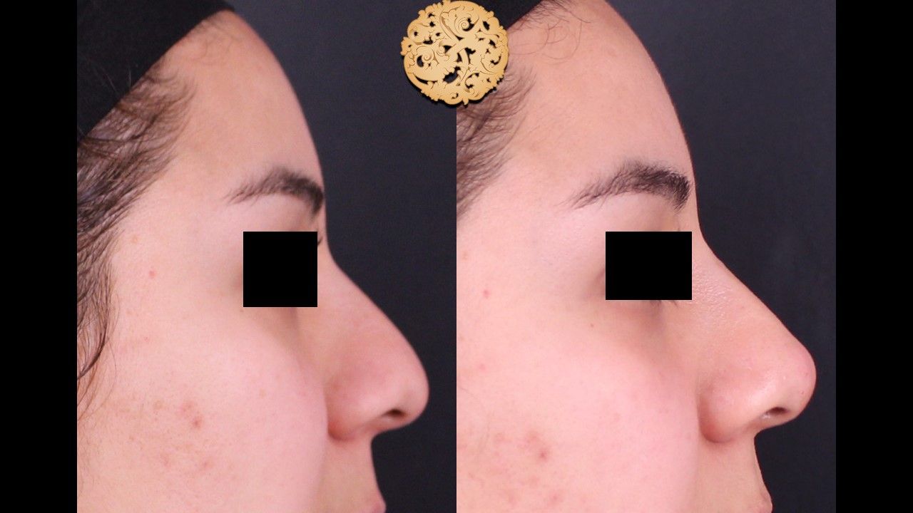 Non Surgical Nose Job Before & After