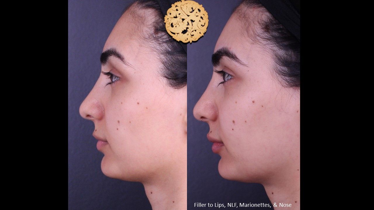 Non Surgical Nose Job Before & After