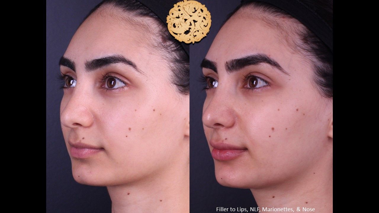 Non Surgical Nose Job Before & After