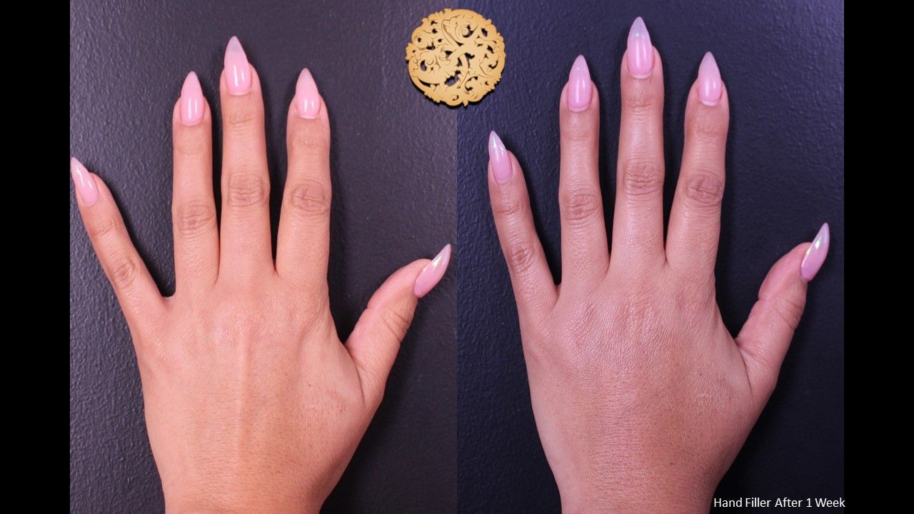Hand Rejuvenation Before & After