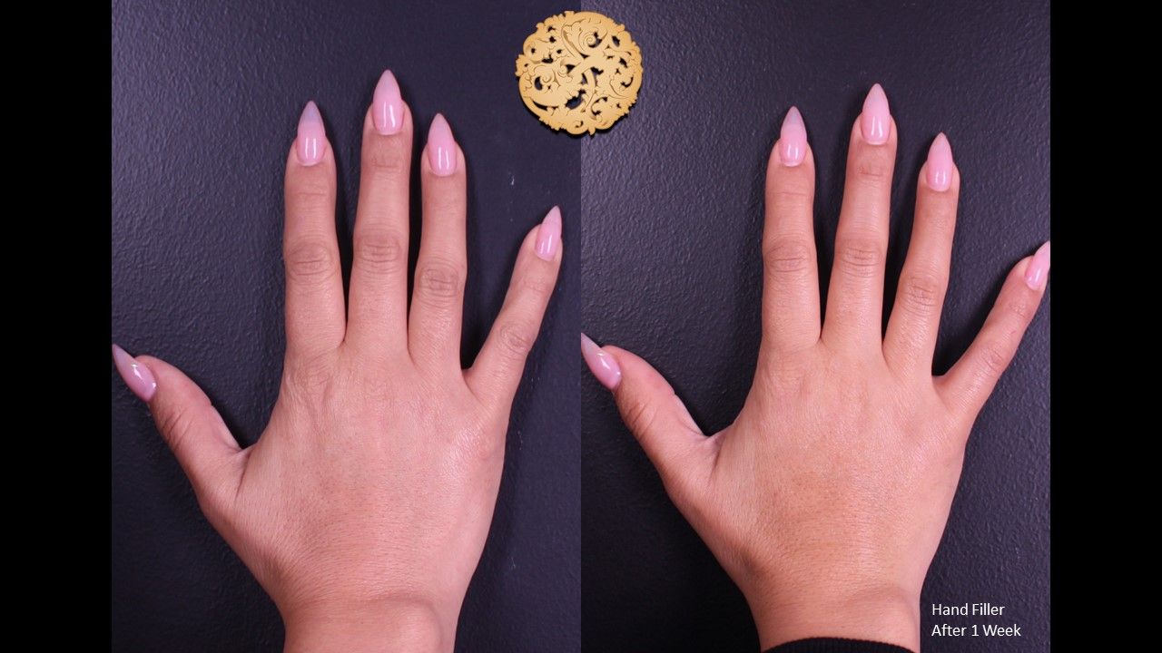 Hand Rejuvenation Before & After