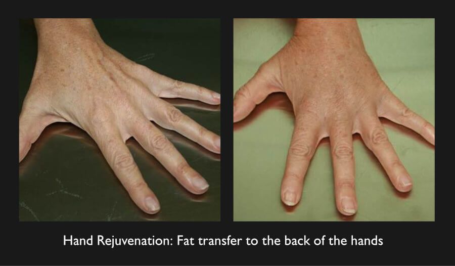 Hand Rejuvenation Before & After