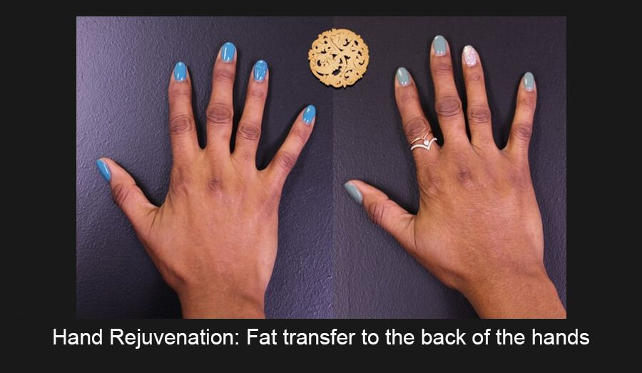 Hand Rejuvenation Before & After